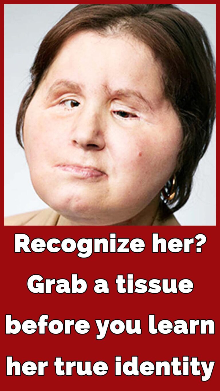 The amazing story of Katie Stubblefield: She became the youngest person to receive a face transplant