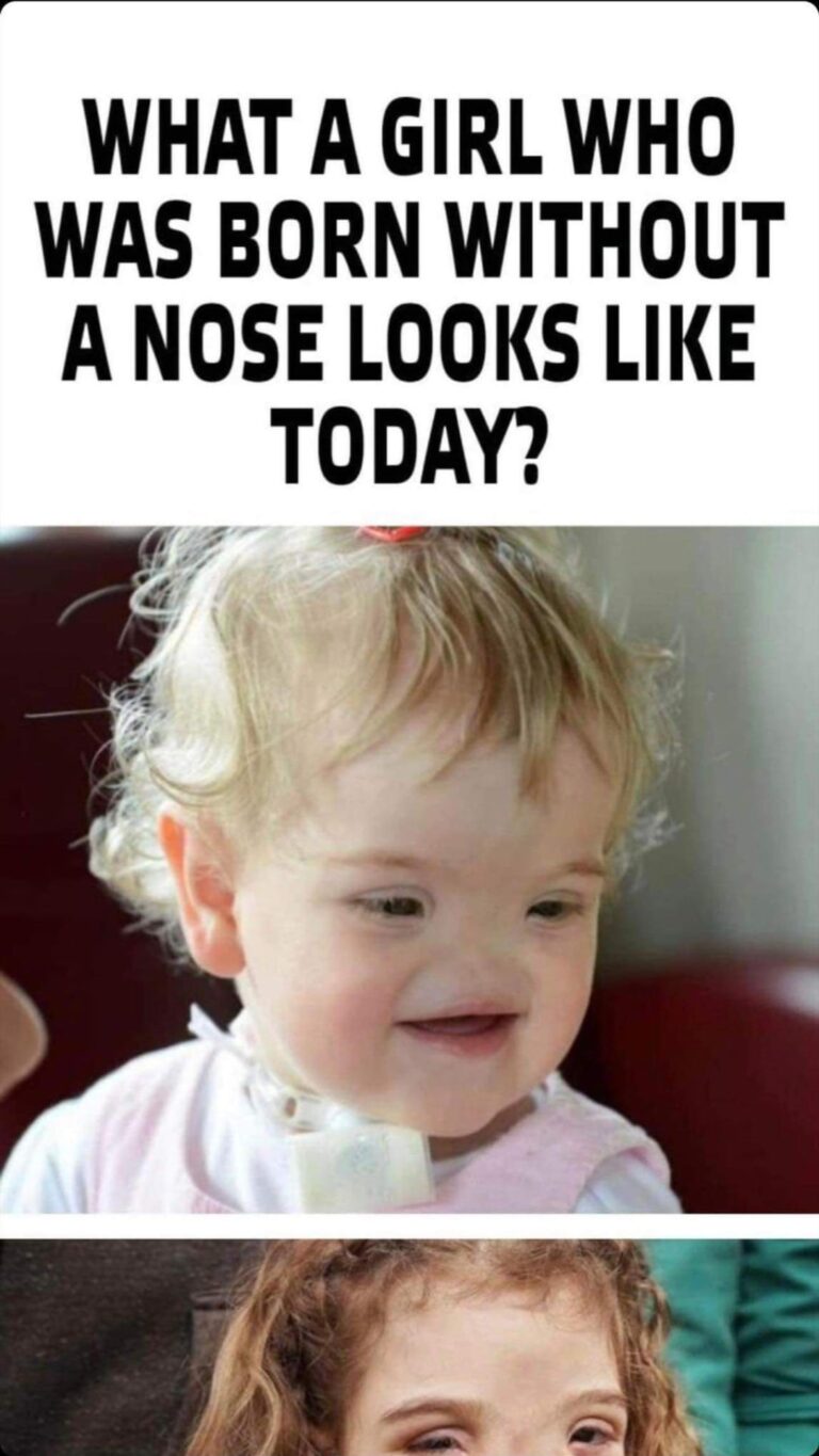 What the noseless girl looks like nowadays