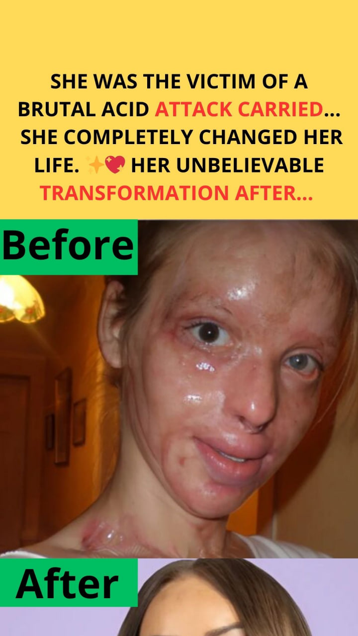 Acid attack survivor reveals her incredible transformation after 16 years of struggle.