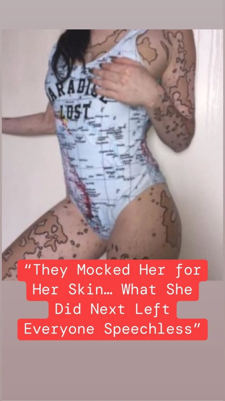 After Suffering ‘criticism’ For Vitiligo, This Girl Transformed Her Body Into Incredible Works Of Art.