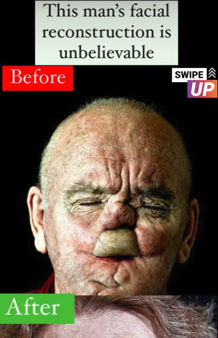 Photographs are taken of individuals going through the process of facial reconstruction to create a series of compelling images…