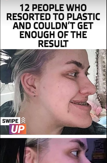 12 People Who Resorted To Plastic And Couldn’t Get Enough Of The Result: Amazing Before/After Photos!
