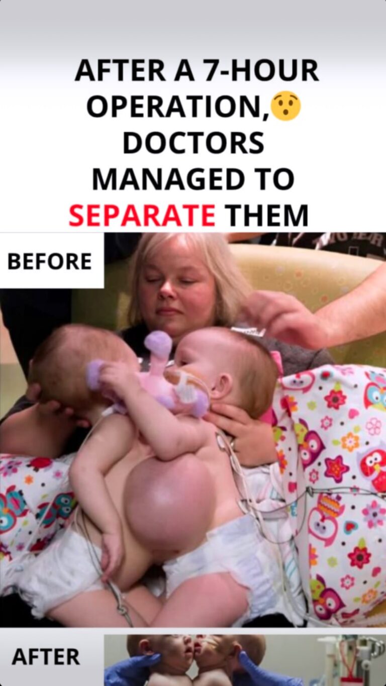 Conjoined twins separated after 7-hour surgery – This is them today
