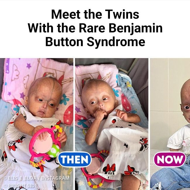 Meet the Twins With the Rare Benjamin Button Syndrome