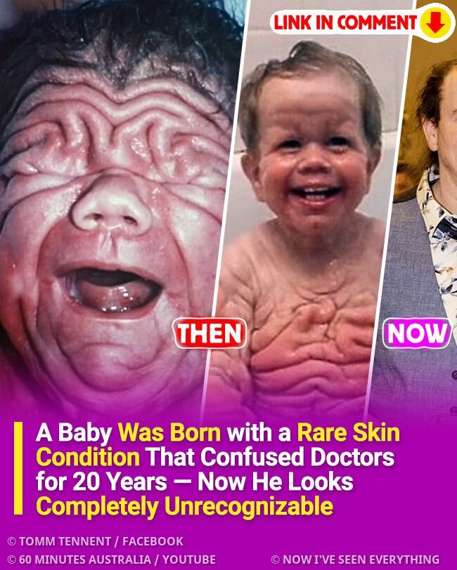 A Baby Was Born with a Rare Skin Condition That Confused Doctors for 20 Years — Now He Looks Completely Unrecognizable