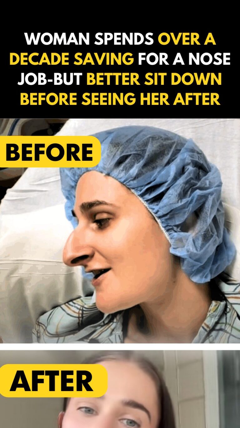 Woman Spends Over A Decade Saving For A Nose Job—But Better Sit Down Before Seeing Her After