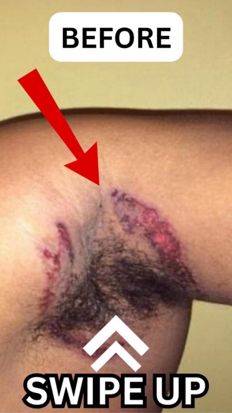 Body Acne: 10 Tips To Get Rid Of Them