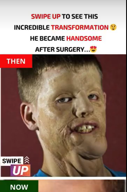 The United States has seen its second full-face transplant with Mitch Hunter… See the result below…